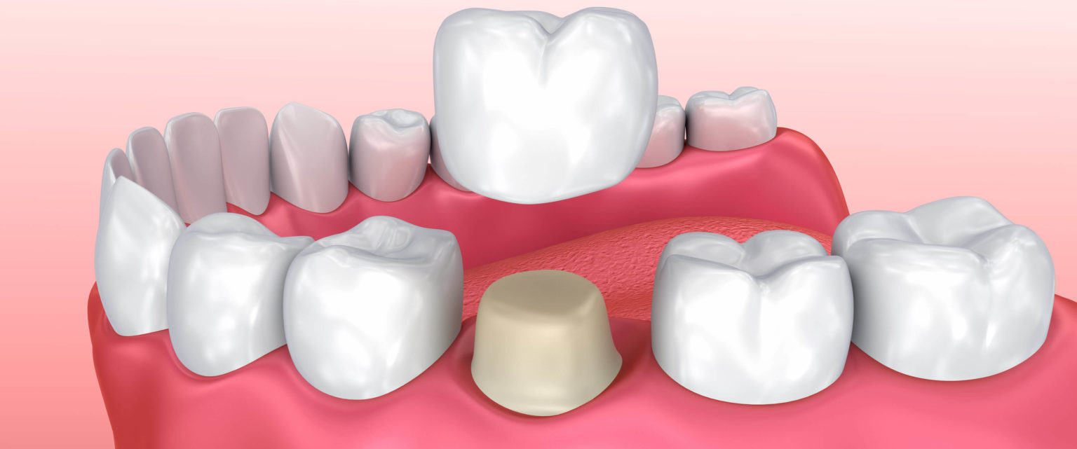 dental crowns treatment antalya