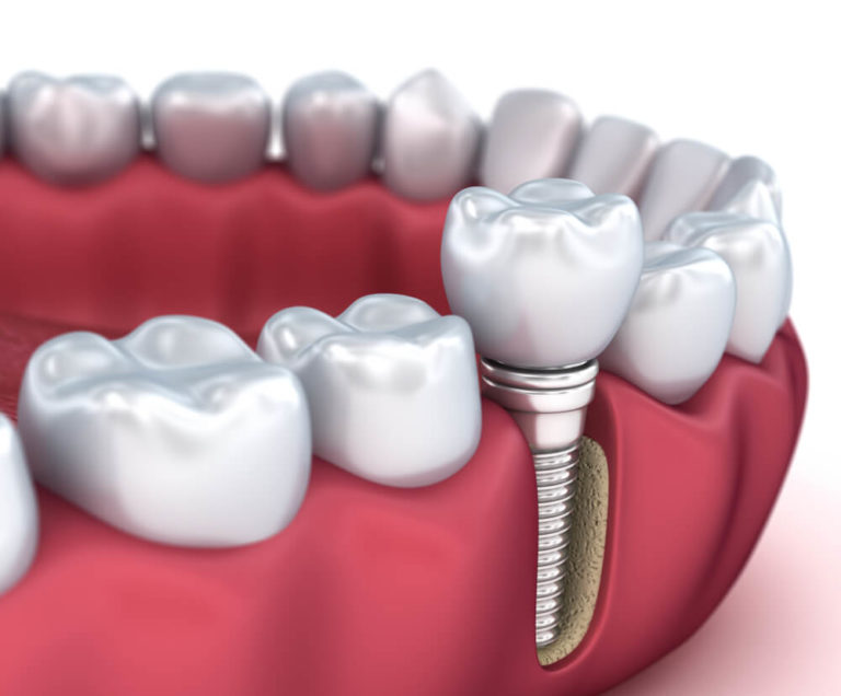 Dental Implant treatment alanya-turkey