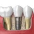 popular dental treatment