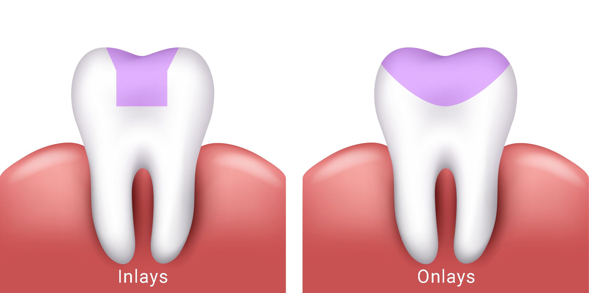 Aesthetic Filling (Bonding) treatment antalya