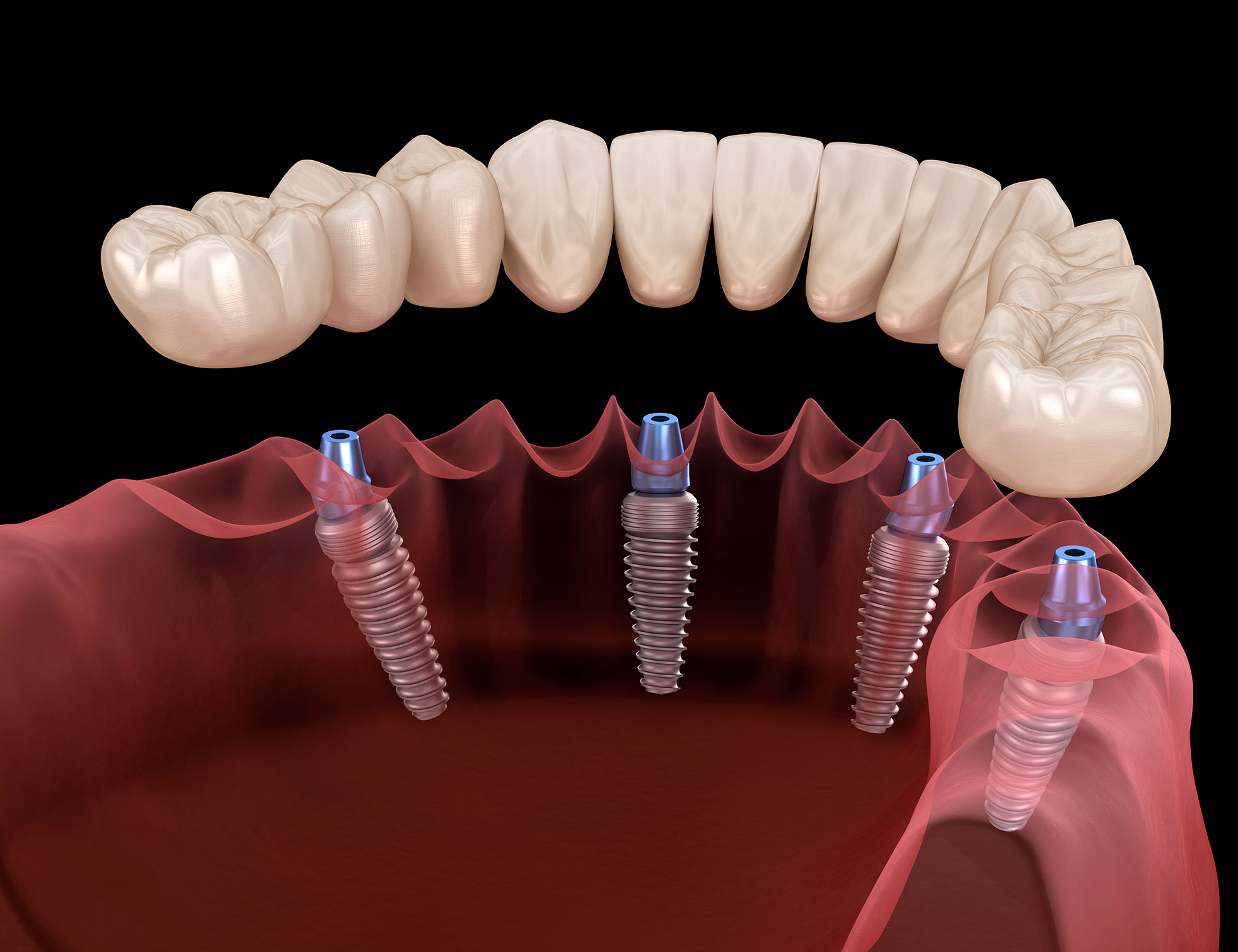 Same Day Implants