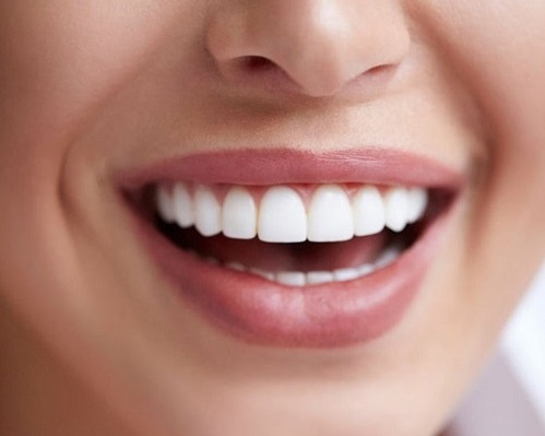 Aesthetic Filling (Bonding) treatment antalya