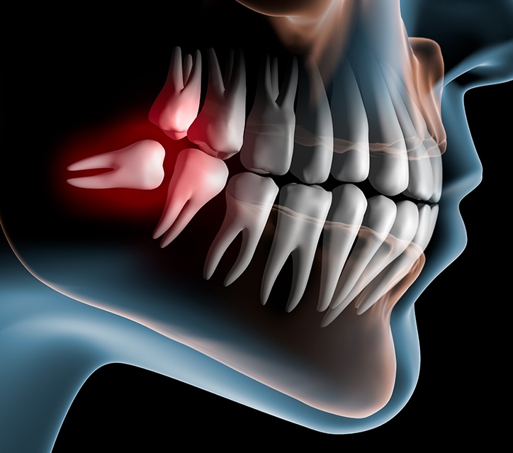 Wisdom Teeth
